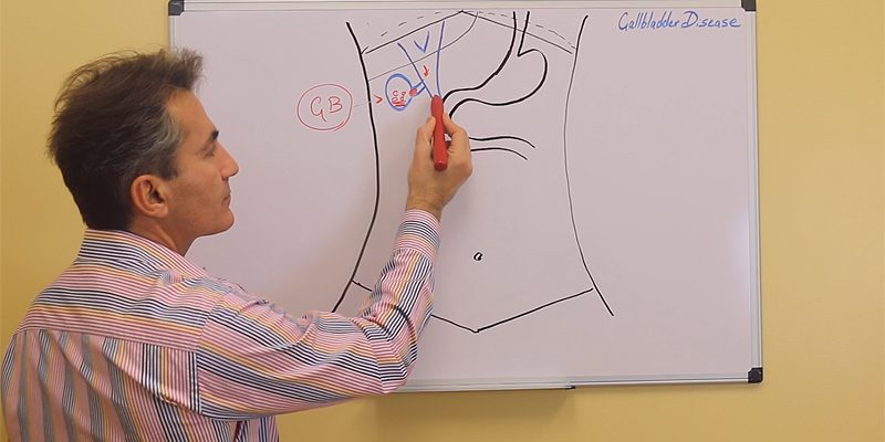 Gallbladder Disease Educational Videos Gallbladder Disease Educational Videos by Dr Iraniha