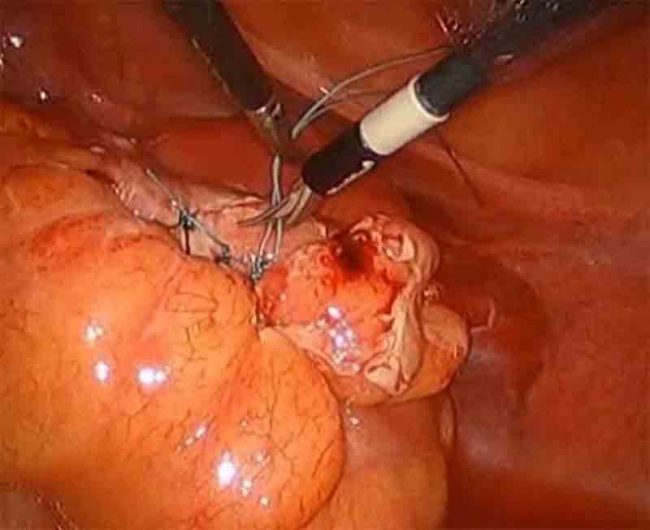 Laparoscopic primary repair of perforated diverticulitis Laparoscopic primary repair of perforated diverticulitis by Dr. Iraniha