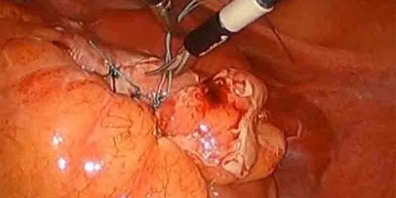 Laparoscopic primary repair of perforated diverticulitis by Dr. Iraniha