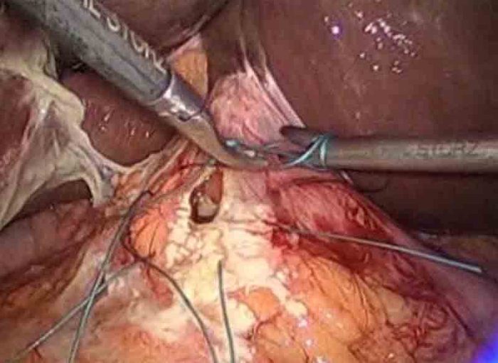 Laparoscopic surgery repair of perforated pre-pyloric gastric ulcer by Dr. Iraniha