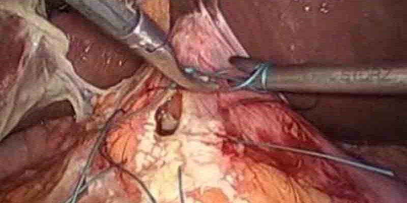 Laparoscopic surgery repair of perforated pre-pyloric gastric ulcer by Dr. Iraniha