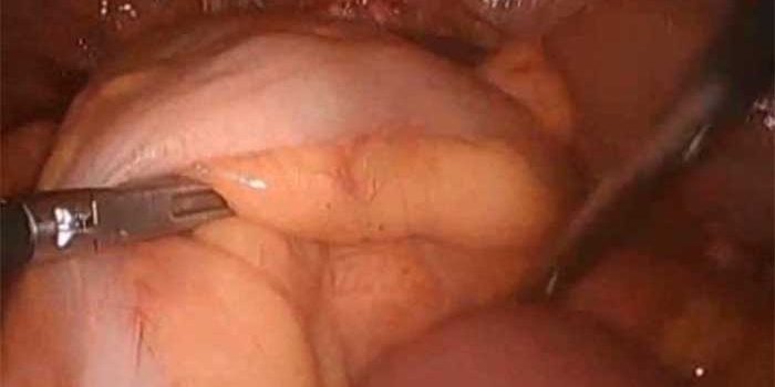 Laparoscopic-Intra-Corporeal-Anastomotic-Technique by Dr. Iraniha