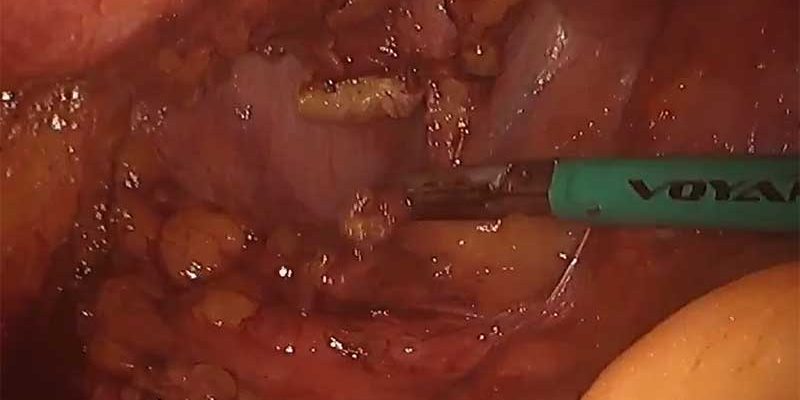 Laparoscopic right Hemicolectomy for colon cancer with Intracorporeal Anastomosis by Dr. Iraniha