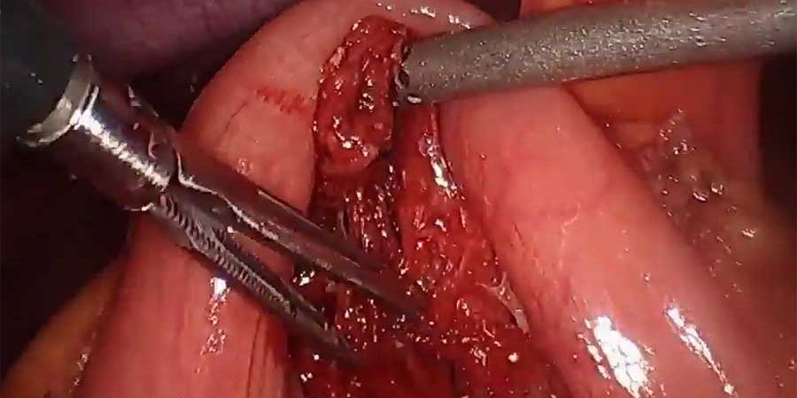 Dr Iraniha- Laparoscopic removal of gastric foreign body with primary repair of the gastric defect by Dr. Iraniha