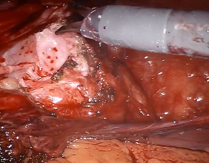 Robotic assistd TAPP for giant scrotal hernia by Dr. Iraniha