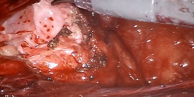 Robotic assistd TAPP for giant scrotal hernia by Dr. Iraniha