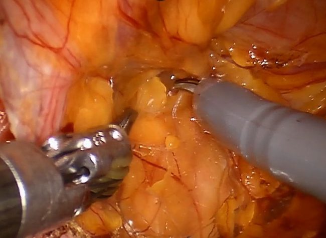 Robotic assisted inguinal and femoral hernia in a female patien Robotic assisted inguinal and femoral hernia in a female patient by Dr Iraniha
