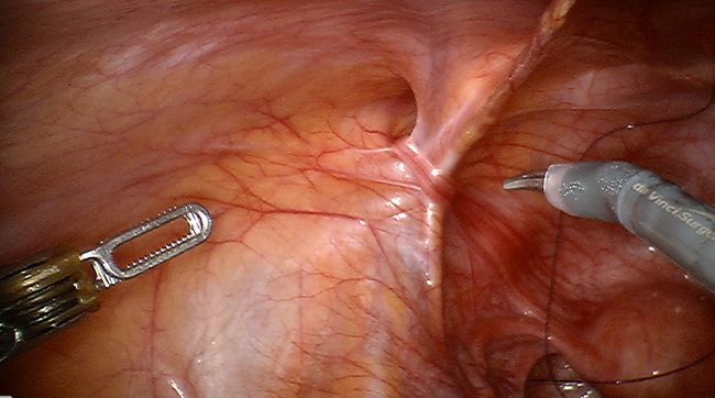 Hernias in women Hernias in women by Dr Iraniha