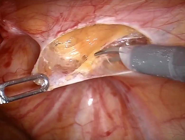 Robotic assisted repair of recurrent right inguinal hernia with mesh