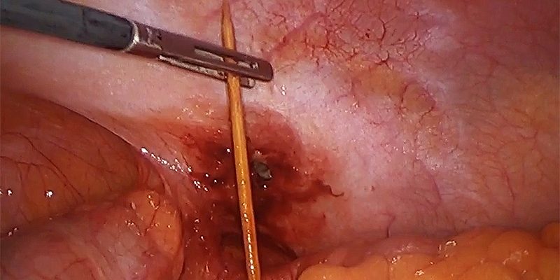 Laparoscopic removal of a toothpick from the large intestine. Laparoscopic removal of a toothpick from the large intestine by Dr. Iraniha