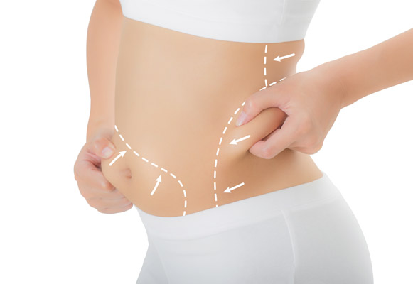 Liposuction or Lipo-Sculpture