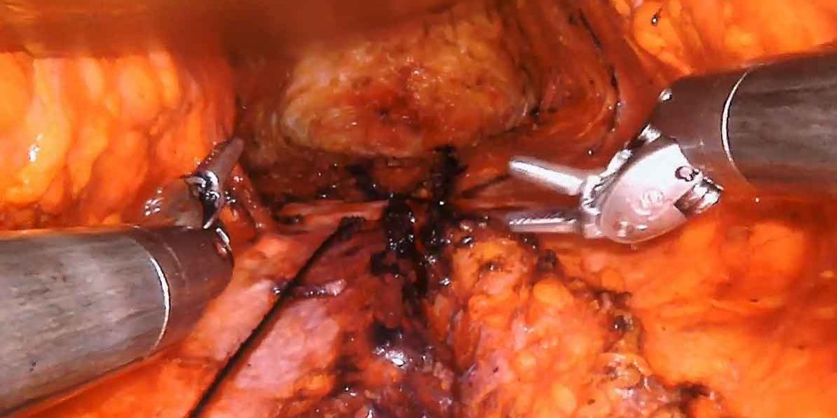 Robotic Assisted Mini Tummy Tuck by Dr. Irahiha