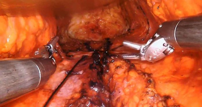 Robotic Assisted Mini Tummy Tuck by Dr. Irahiha