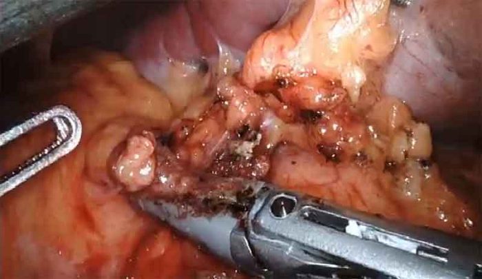Robotic Splenectomy by Dr.Iraniha