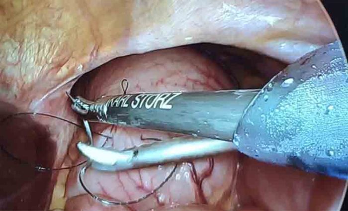 Dr Iraniha Laparoscopic Technique for Placement of a Gastrostomy Tube