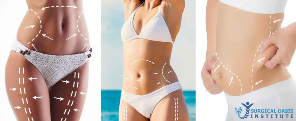 Orange County Body Contouring