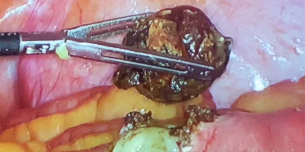 Laparoscopic Management of Gallstone Ileus by Dr. Iraniha