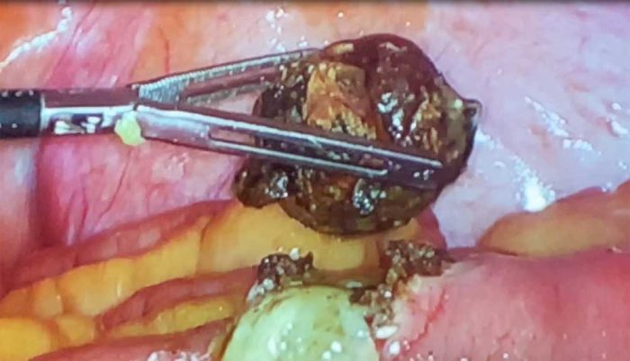 Laparoscopic Management of Gallstone Ileus by Dr. Iraniha