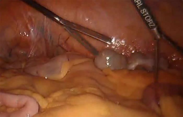 Laparoscopic Right Colectomy by Dr. Iraniha