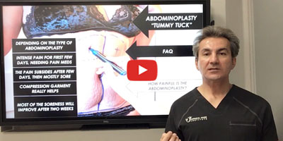 About tummy tuck surgery By Dr. Iraniha
