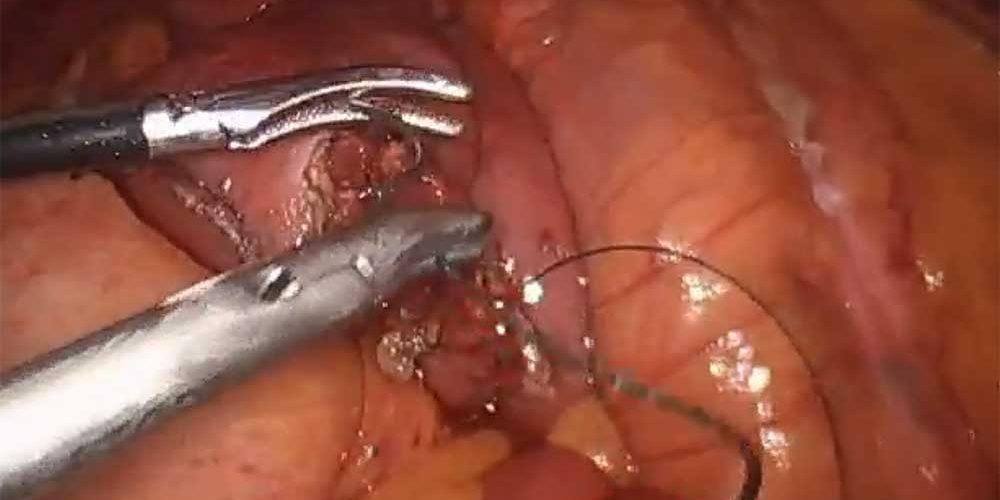 Laparoscopic small bowel resection Laparoscopic small bowel resection by Dr. Iraniha