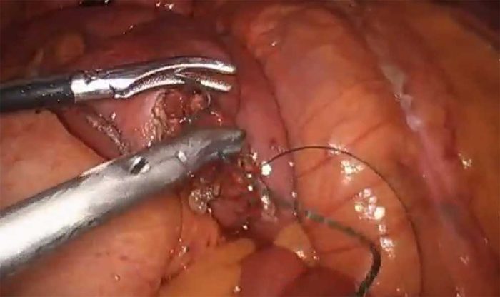 Laparoscopic small bowel resection by Dr. Iraniha