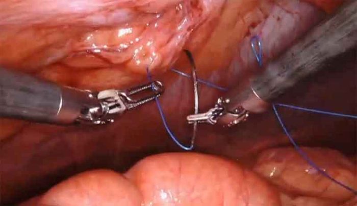Robotic ventral hernia repair with mesh by Dr. Iraniha