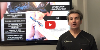 What are the potential complications of liposuction by Dr. Iraniha