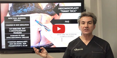What are the potential complications of tummy tuck surgery by Dr. Iraniha