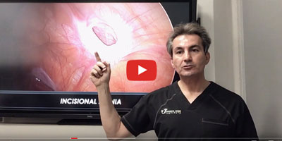 What is an incisional hernia - Dr. Iraniha