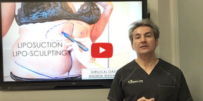 What is liposuction or lipo sculpting by Dr. Iraniha
