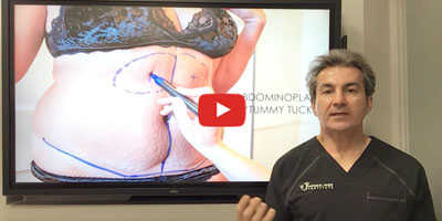 What is mini tummy tuck by Dr. Iraniha