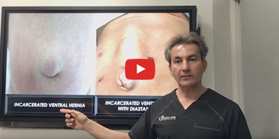 What is the diastasis recti - Dr. Iraniha