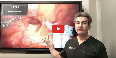 What is the natural history of hernia by Dr. Iraniha