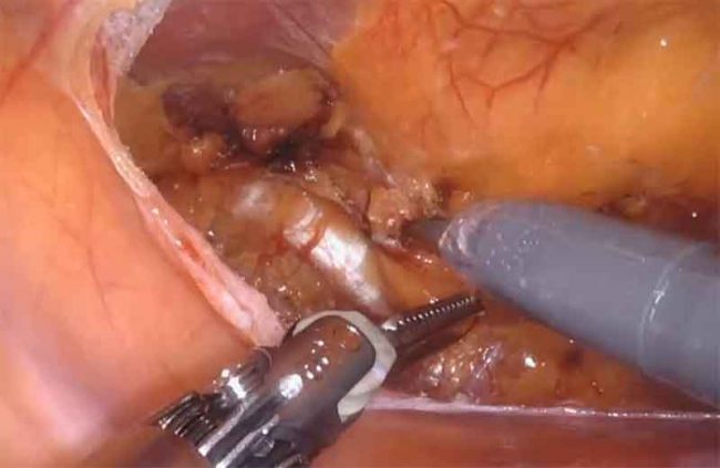 Robotic bilateral inguinal hernia repair with mesh Robotic bilateral inguinal hernia repair with mesh by Dr. Iraniha