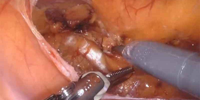 Robotic bilateral inguinal hernia repair with mesh by Dr. Iraniha
