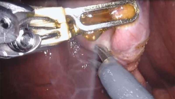 Robotic Cholecystectomy by Dr. Iraniha