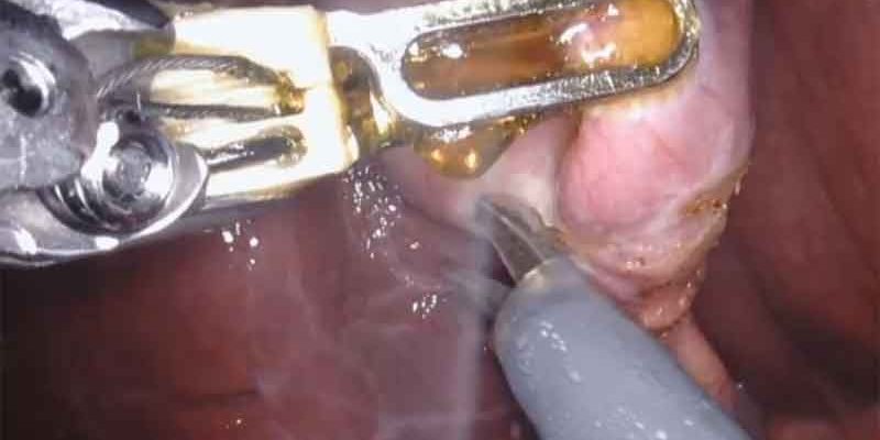 Robotic Cholecystectomy by Dr. Iraniha