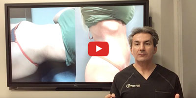 Can diastasis recti be repaired with minimally invasive surgery by Dr. Iraniha