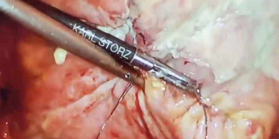 Laparoscopic-repair-of-ruptured-bladder by Dr. Iraniha