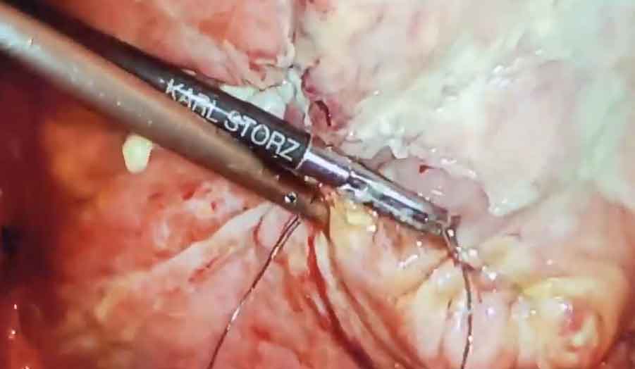 Laparoscopic-repair-of-ruptured-bladder by Dr. Iraniha