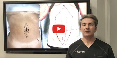 What are the different techniques for repairing the diastasis recti by Dr. Iraniha