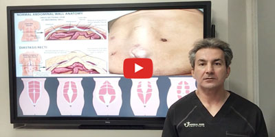 What is diastasis of rectus muscles by Dr. Iraniha