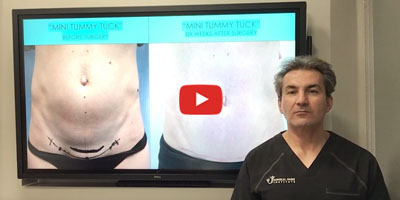 Who is the best candidate for the mini abdominoplasty by Dr. Iraniha