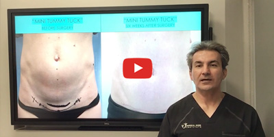 Who is the best candidate for a mini abdominoplasty or tummy tuck? By Dr. Iraniha