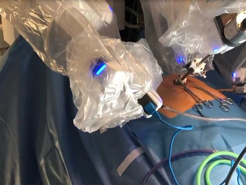 Dr. Iraniha performing robotic inguinal hernia repair - Surgical Oasis Institute