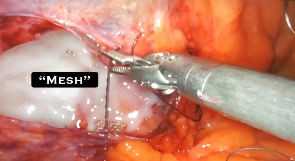 How I hide the mesh behind the muscle during laparoscopic inguinal hernia repair by Dr. Iraniha