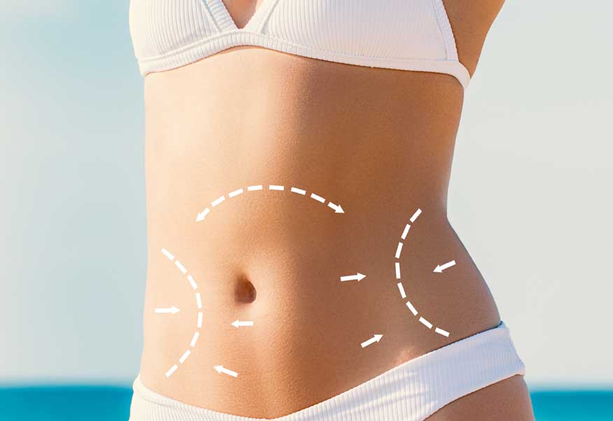 What is tummy tuck by Dr. Iraniha