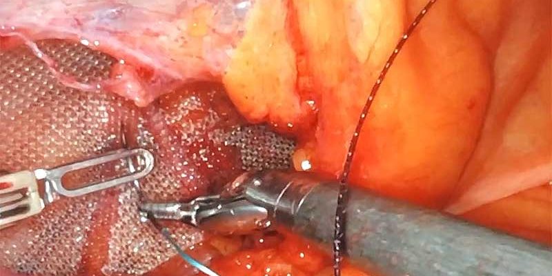 Dr. Iraniha - How to perform laparoscopic bowel anastomosis surgery