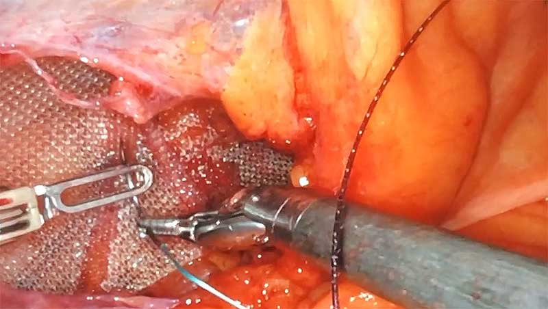 Dr. Iraniha - How to perform laparoscopic bowel anastomosis surgery